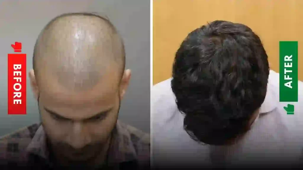 बाल झड़ने से रोकने के घरेलू उपाय